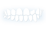 UNDERBITE